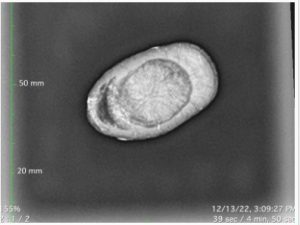 One of the most remarkable discoveries made on the Asylum Hill Project has been a calcified, or "porcelain" gallbladder. This is an X-ray image of the organ identified by Dr. Ralph Didlake, a retired surgeon and the director of the project.